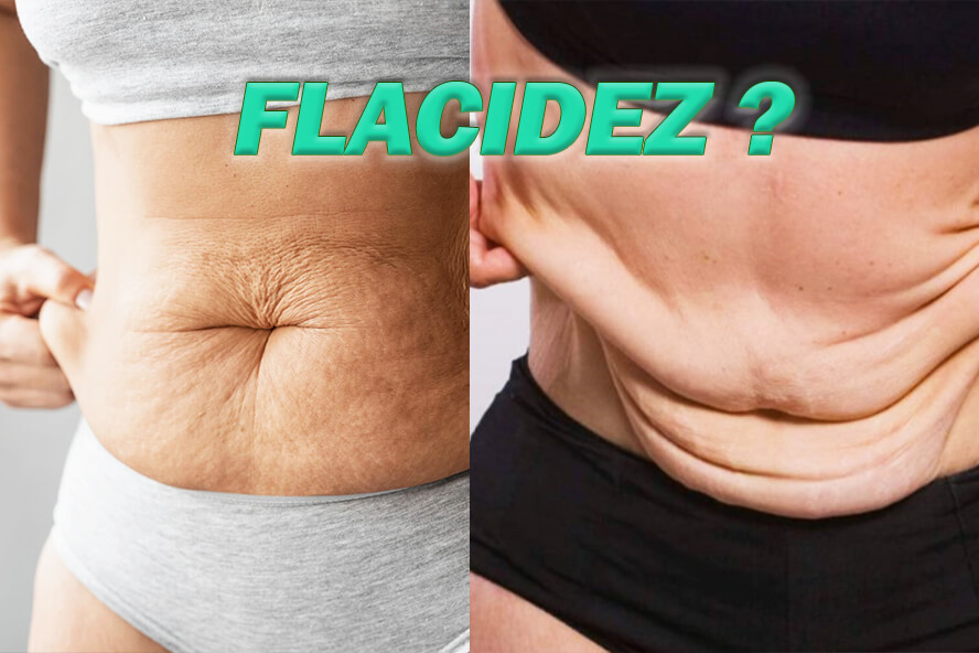 Flacidez-Ozempic